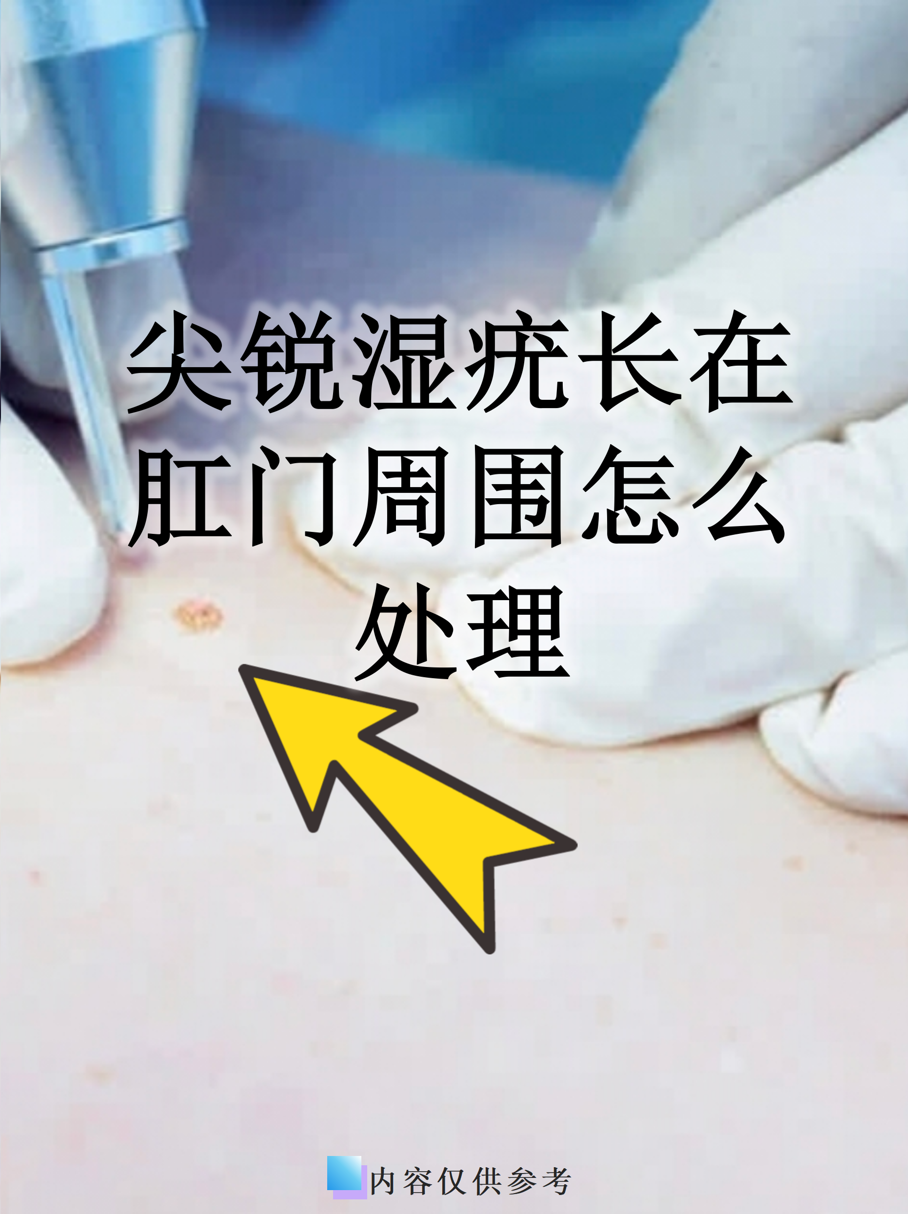 尖锐湿疣怎么治疗才能根治好治吗_(尖锐湿疣治疗最佳办法)