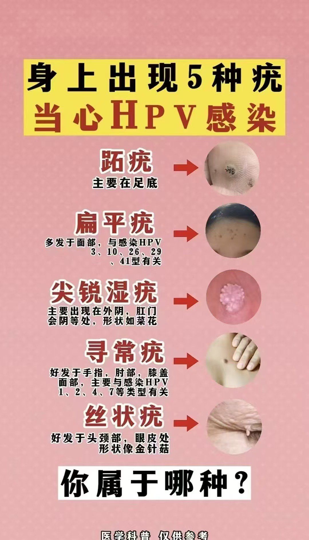 尖锐湿疣怎么治疗才能根治_(尖锐湿疣怎么治疗才能根治口腔)  第1张